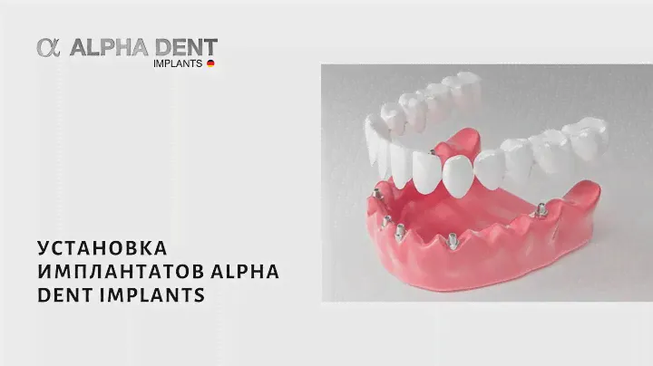 Установка имплантатов Alpha Dent Implants