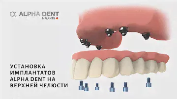 Установка имплантатов Alpha Dent на верхней челюсти | др. Коробцев В. И. | Alpha Dent Implants