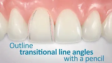Polychromatic Direct Veneer with Dr. Newton Fahl