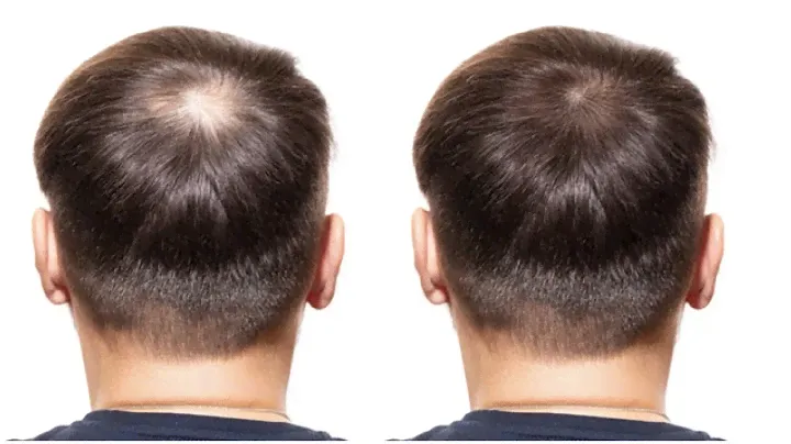 6 Foods That Can Block DHT and Fight Hair Loss.