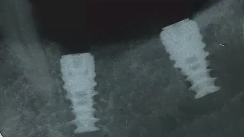 Alpha Bio Implant placement