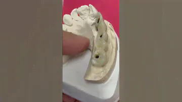 3 Custom Abutments for 4-Unit Zirconia