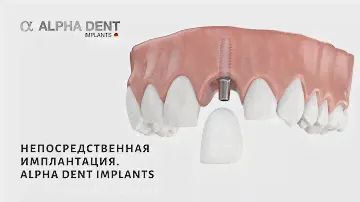 Непосредственная имплантация. Alpha Dent Implants